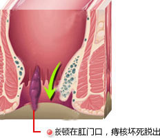 为什么痔疮反复发作?